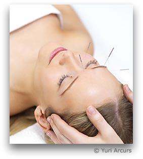 Illustration Akupunktur